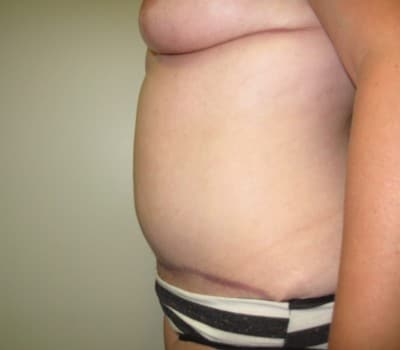 After Image: Abdominoplasty - other