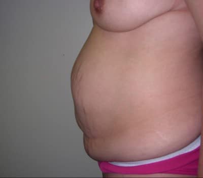 Before Image: Abdominoplasty - other