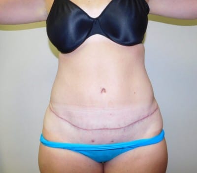 After Image: Abdominoplasty - front