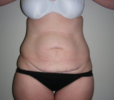 Before Image: Abdominoplasty - front