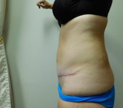 After Image: Abdominoplasty - other