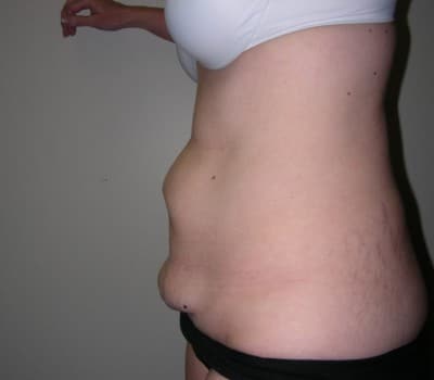 Before Image: Abdominoplasty - other