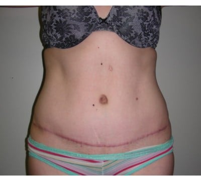 After Image: Abdominoplasty - front