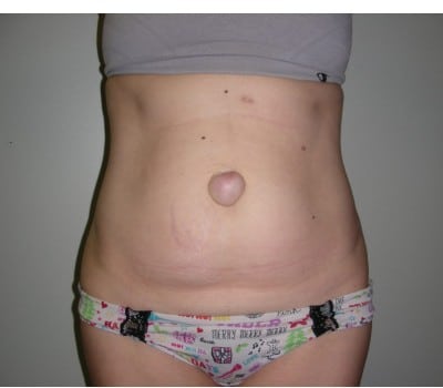 Before Image: Abdominoplasty - front
