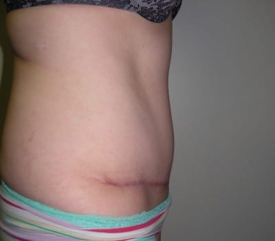 After Image: Abdominoplasty - other