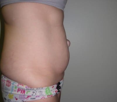 Before Image: Abdominoplasty - other