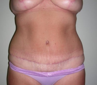 After Image: Abdominoplasty - front