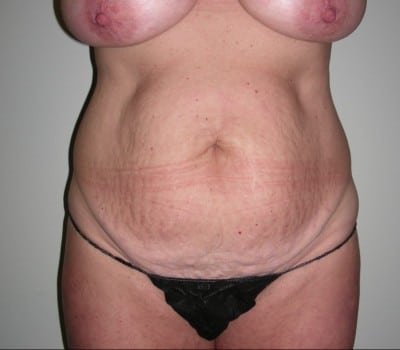 Before Image: Abdominoplasty - front