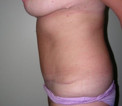 After Image: Abdominoplasty - other