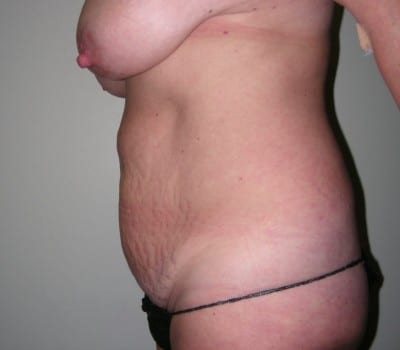 Before Image: Abdominoplasty - other
