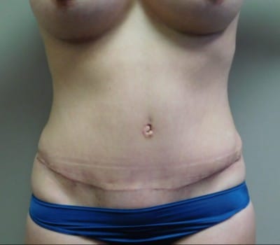 After Image: Abdominoplasty - front