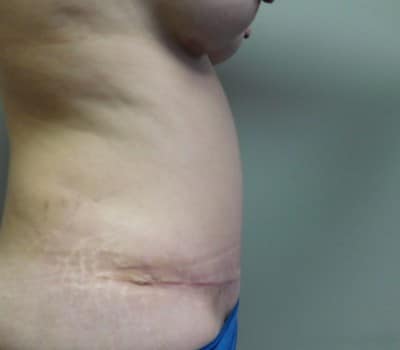 After Image: Abdominoplasty - other
