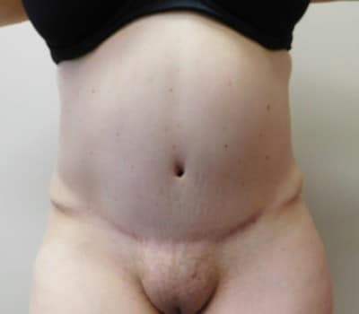 After Image: Abdominoplasty - front