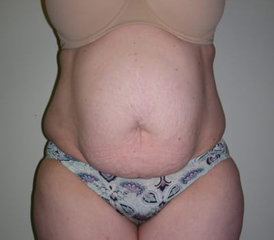 Before Image: Abdominoplasty - front
