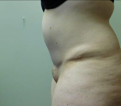 After Image: Abdominoplasty - other