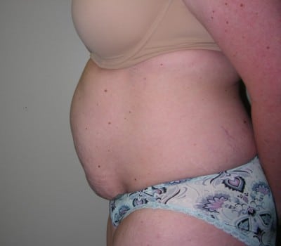 Before Image: Abdominoplasty - other