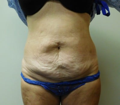 Before Image: Abdominoplasty - front