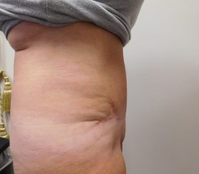 After Image: Abdominoplasty - other