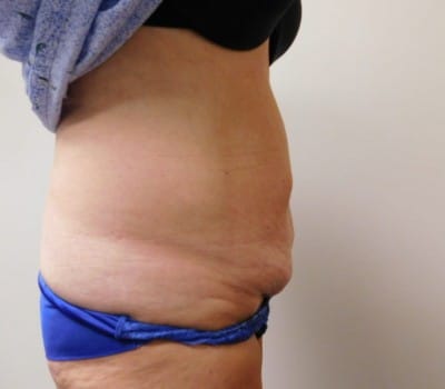 Before Image: Abdominoplasty - other