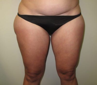 Before Image: 40yo female interested in debulking her assymetric outer thighs. - front