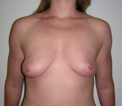 Before Image: Submuscular smooth round silicone gel implants placed with 350cc on the right and 375cc on the left - front