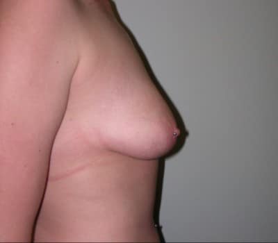 Before Image: Submuscular smooth round silicone gel implants placed with 350cc on the right and 375cc on the left - front