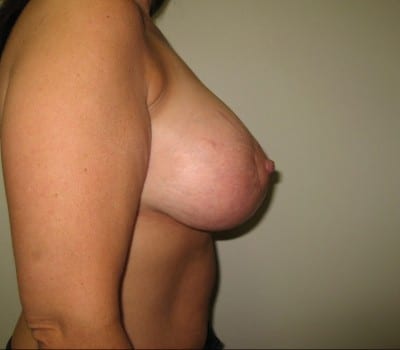 After Image: Submuscular smooth round saline implants placed with 230cc on both sides - front