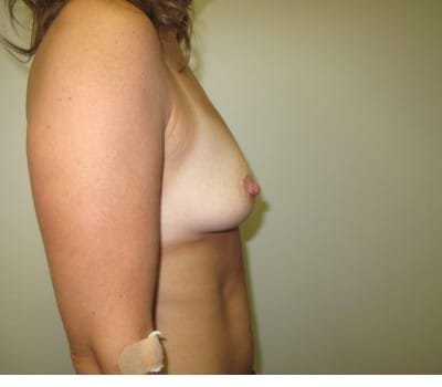 Before Image: 300 cc Gel Implants - other