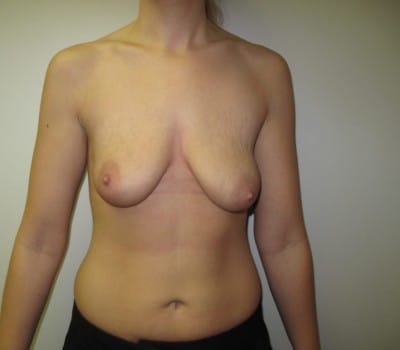 Before Image: 350 CC Silicone Gel Implants - front
