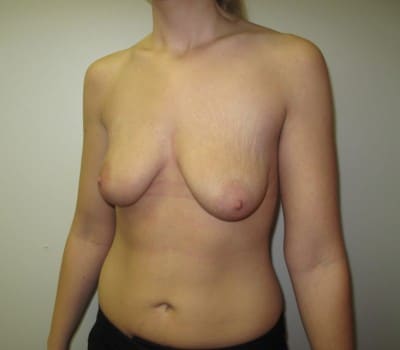 Before Image: 350 CC Silicone Gel Implants - other