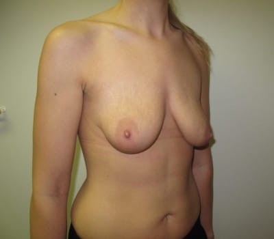 Before Image: 350 CC Silicone Gel Implants - other