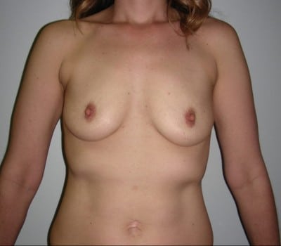 Before Image: 33yo female 4 months after a submuscular augmentation - front