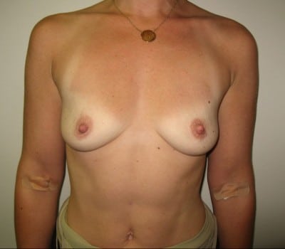 Before Image: 35yo female 350cc’s were placed on both sides - front