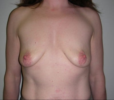 Before Image: 45yo female 400cc’s were placed on both sides - front