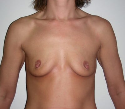 Before Image: 34yo female, 350cc’s were placed on both sides - front