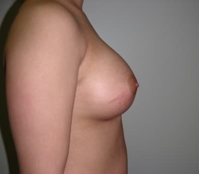 After Image: 22yo female with 350cc’s placed on both sides - other