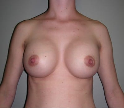 After Image: 24yo female where 400cc’s were placed on both breasts - front