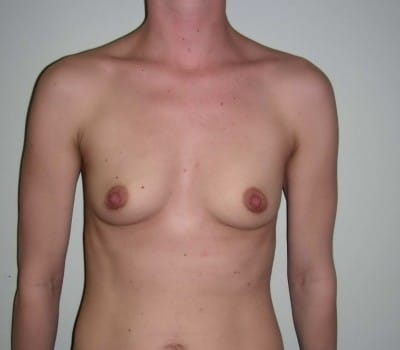 Before Image: 24yo female where 400cc’s were placed on both breasts - front