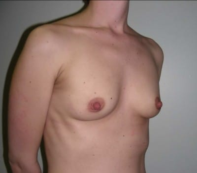 Before Image: 24yo female where 400cc’s were placed on both breasts - other