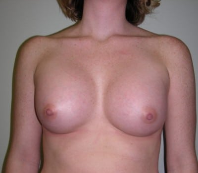 After Image: 29yo female where 350cc’s were placed on both sides - front
