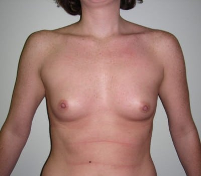 Before Image: 29yo female where 350cc’s were placed on both sides - front