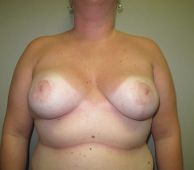 After Image: 29yo where 350cc’s were placed on the right side and 225cc’s on the left. - front