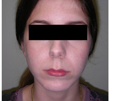 After Image: 23yo female interested in enhancing the projection of her chin - front
