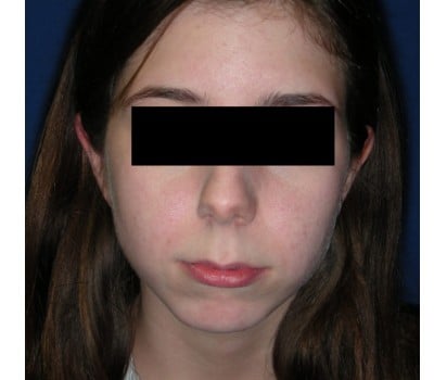 23yo female interested in enhancing the projection of her chin