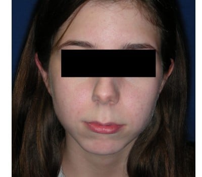 Before Image: 23yo female interested in enhancing the projection of her chin - front