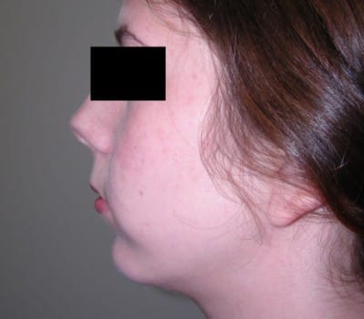 After Image: 23yo female interested in enhancing the projection of her chin - other