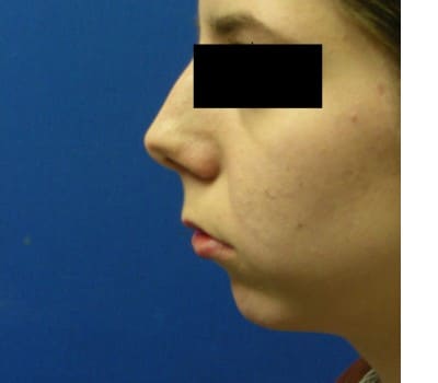 Before Image: 23yo female interested in enhancing the projection of her chin - other