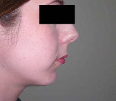 After Image: 23yo female interested in enhancing the projection of her chin - other