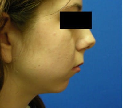 Before Image: 23yo female interested in enhancing the projection of her chin - other