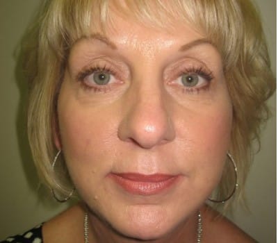 After Image: 56 yo had fat injections & Lipo in neck - front